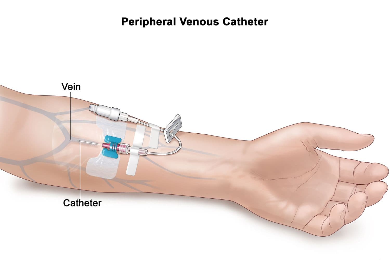 PICC and Midline