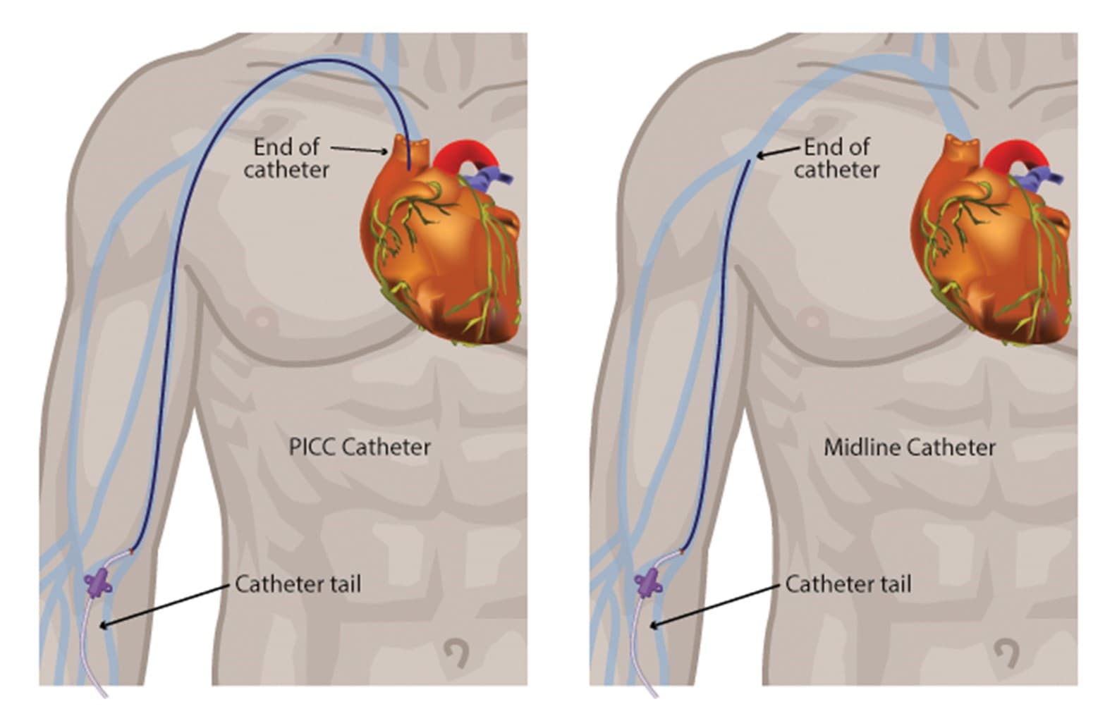 picc vs midline